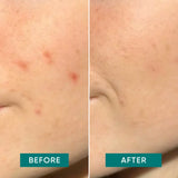 Pimple Patches