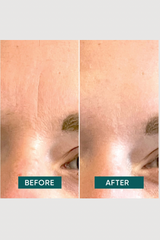 Face Patches with Hyaluronic Acid Mini